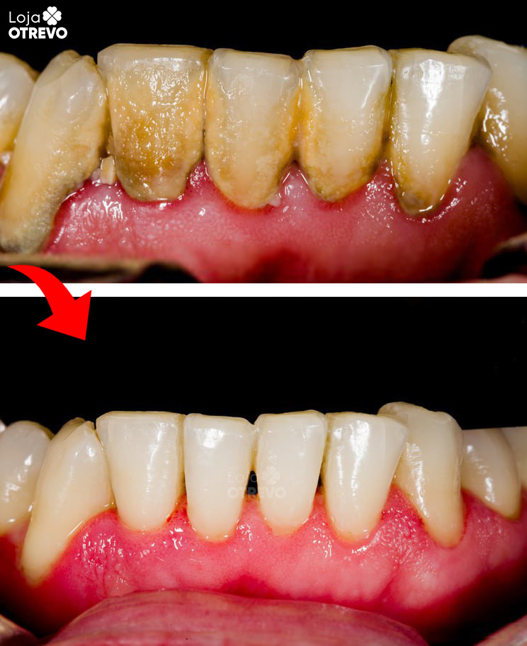 Irrigador bucal para limpieza bucal - JatoClean®