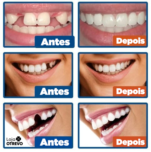 Resina de Reparación temporal de Dientes - WhiteTeeth®