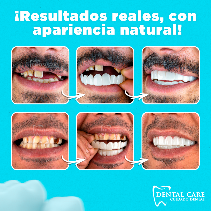 Carillas Dentales Naturales Removible - DentalCare®