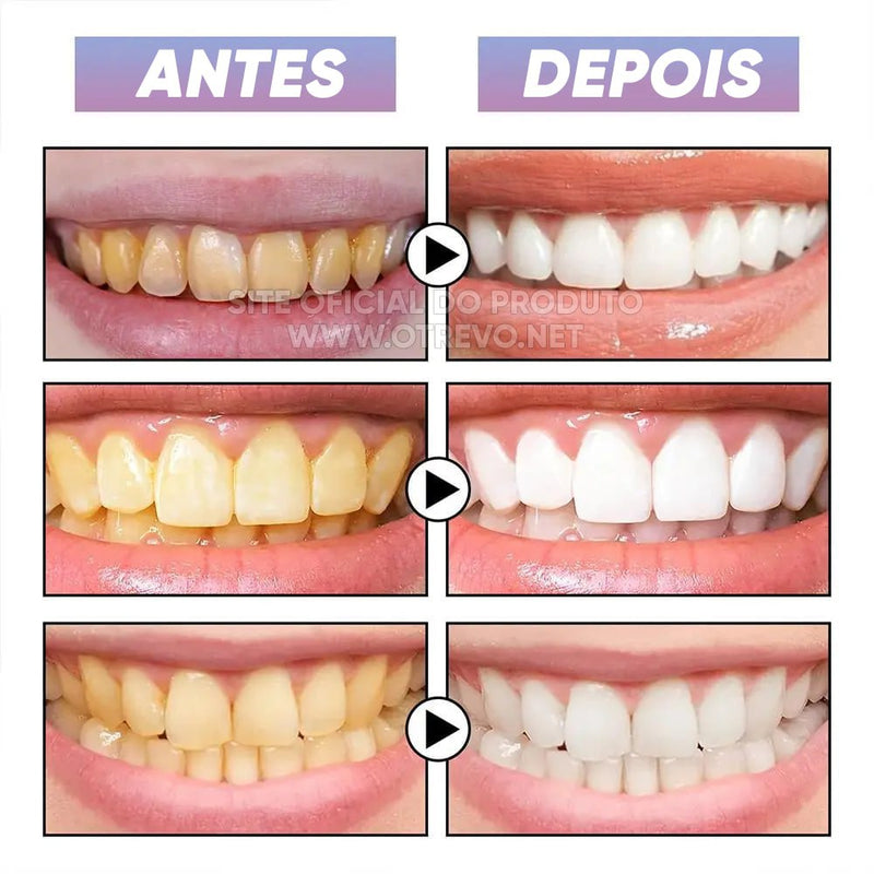 Brillo Blanqueador dental instantáneo- SMILEKIT®